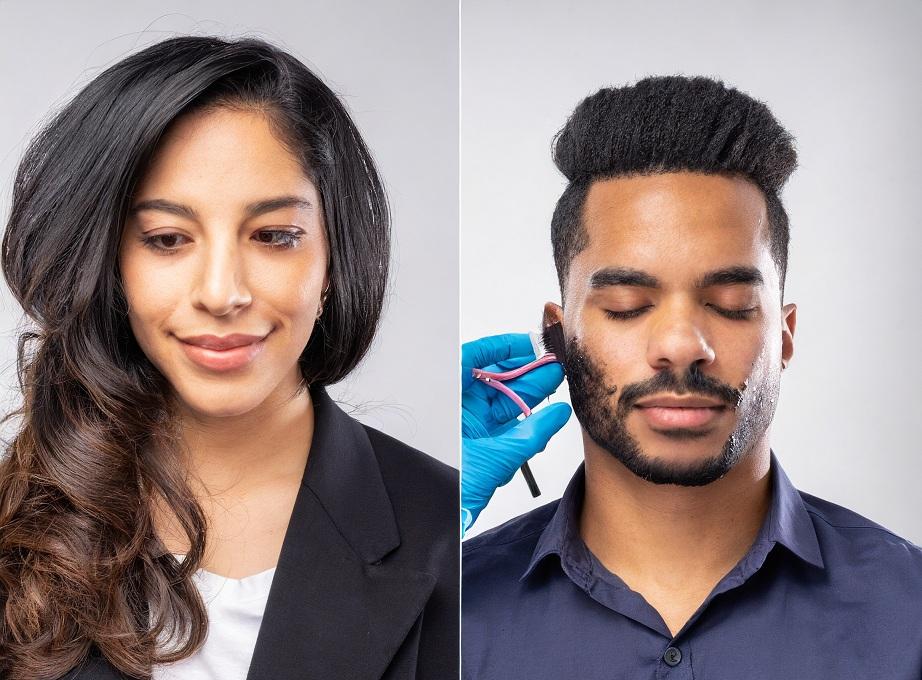 hair transplant before and after