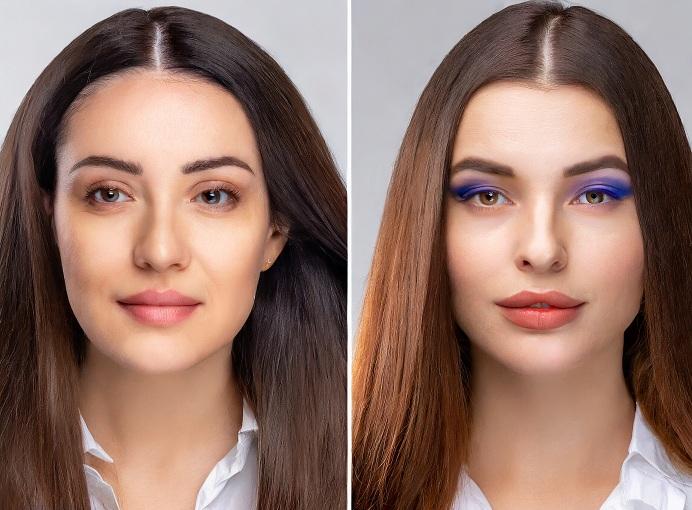 hair transplant before and after