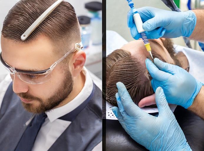 hair transplant before and after male